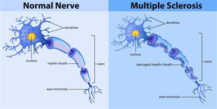What is Multiple Sclerosis?